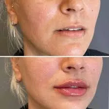 Aumento de labios: diseño biológico para una sonrisa en equilibrio